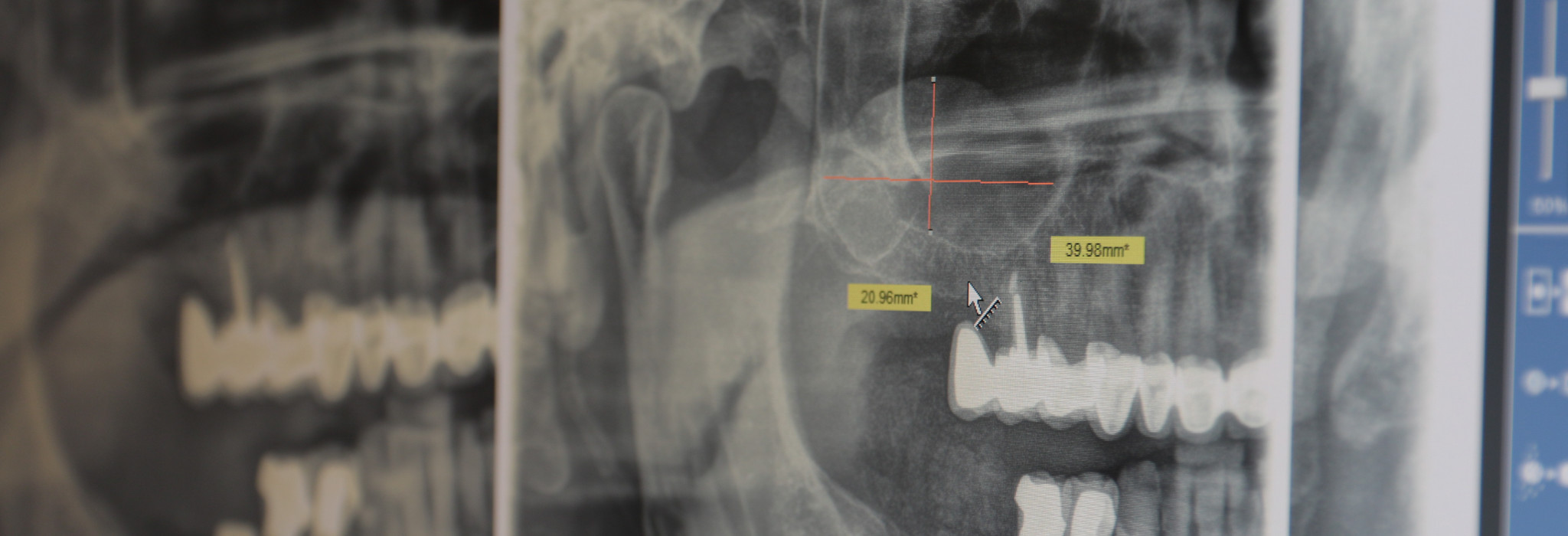 Treatment of Maxillary sinus treatment